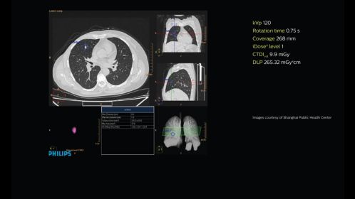 Lung nodule analysis