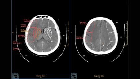 Puntuación de TC ASPECT¹,² que respalda los casos de accidente cerebrovascular isquémico