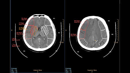 CT ASPECT Scoring¹,² supporting ischemic stroke cases