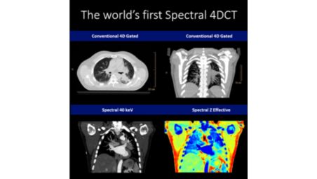 World’s-first spectral 4D CT