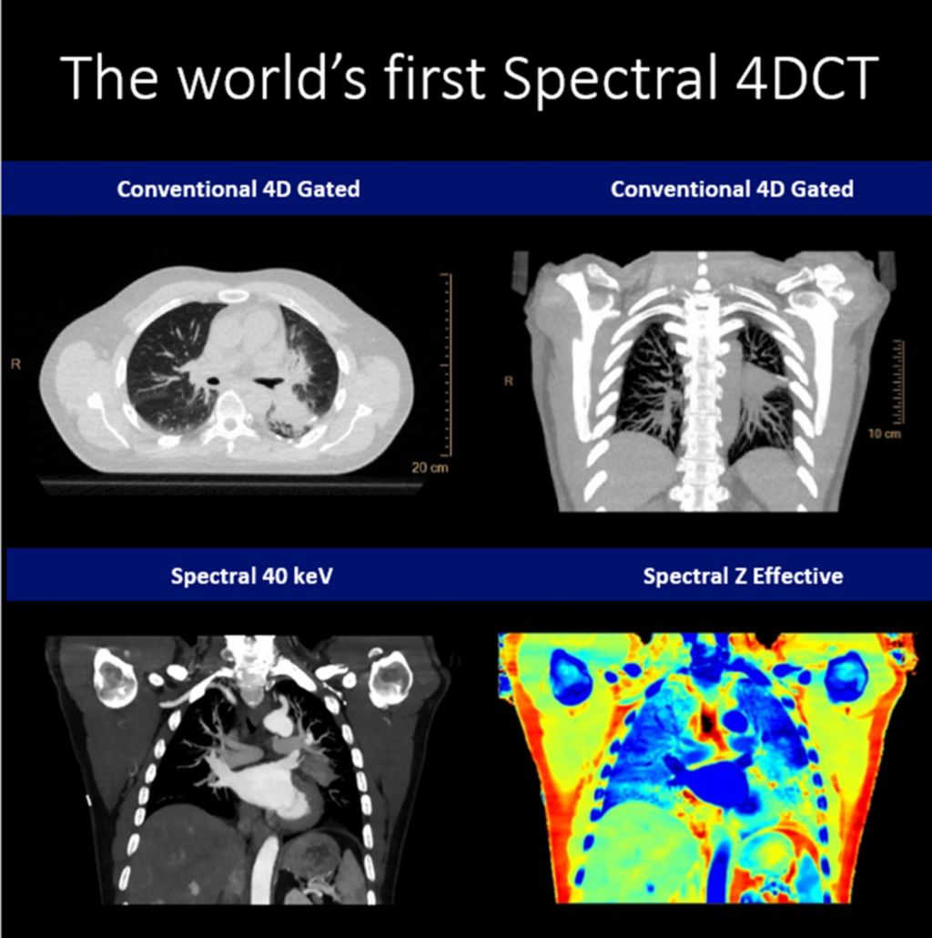 World’s-first spectral 4D CT
