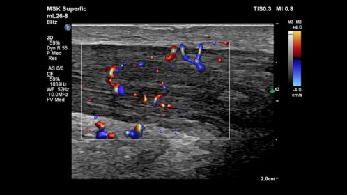 mL26-8 Paired with Flow Viewer on an Inflamed Achilles