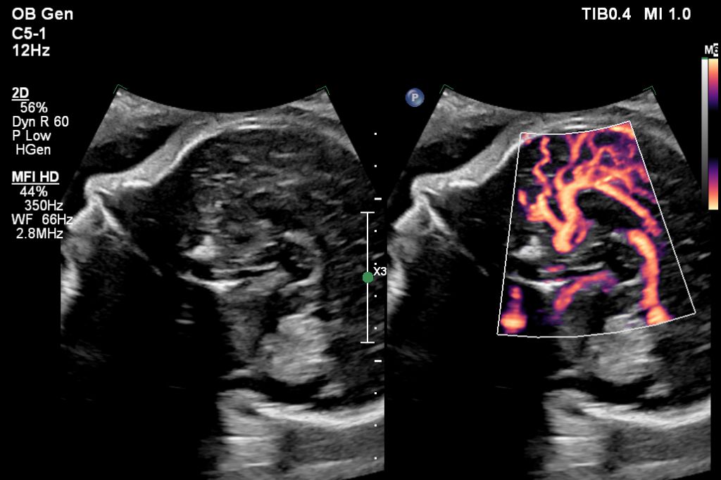 Fetal brain pericallosal artery with MFI HD using C5-1 transducer