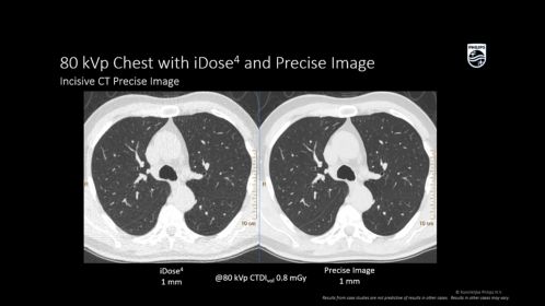 Incisive 80 kVp Thorax avec iDose4 et Precise Image