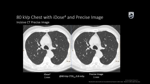 Incisive CT CT Scanner | Philips