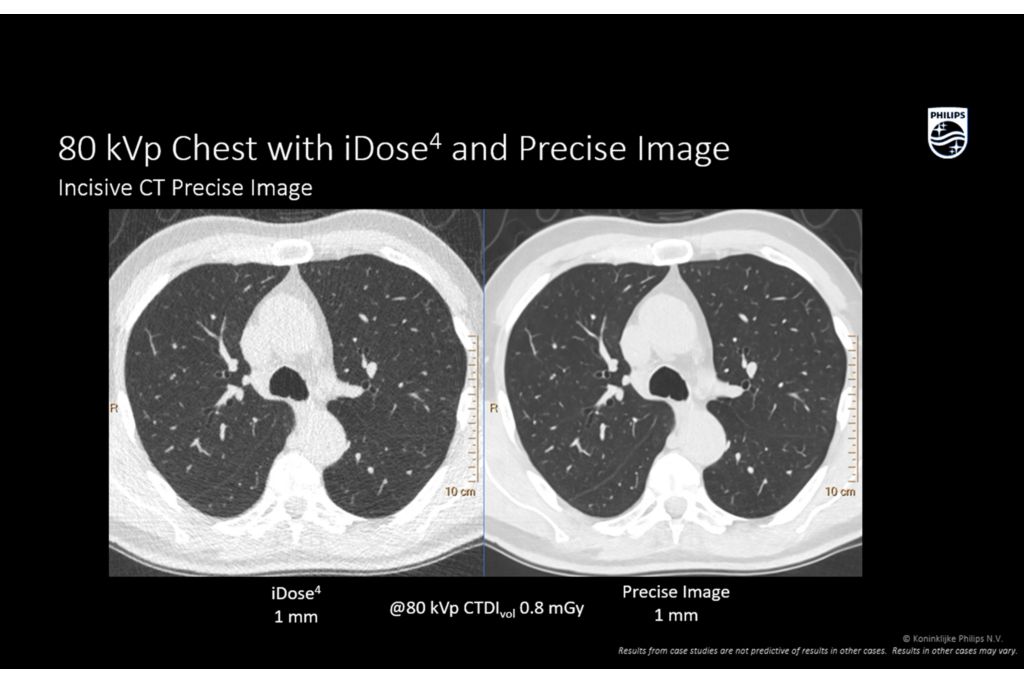 Incisive 80 kVp Chest with iDose4 and Precise image