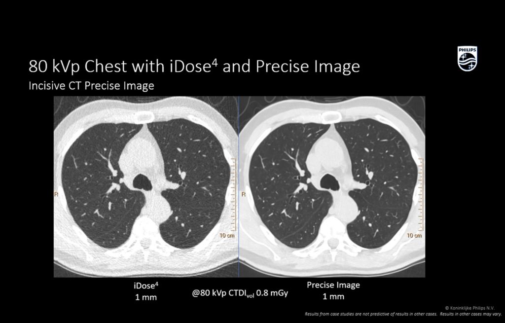 Incisive 80 kVp Chest with iDose4 and Precise image