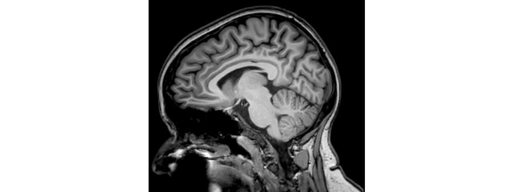 Sagittal 3D T1w FFE - Brain
