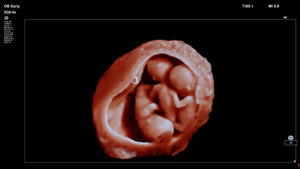 3D Image of triplets with TrueVue and 3D9-3v transducer