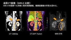 case 85
化膿性脊椎炎