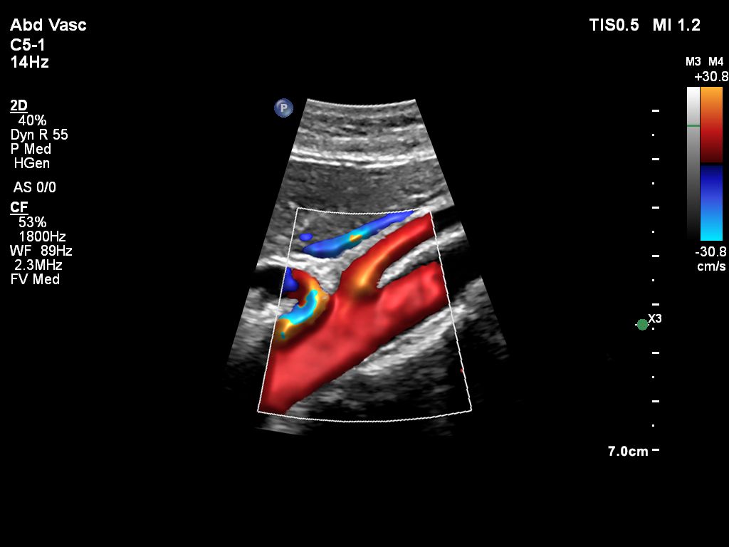 Aorta with Celiac Artery and Superior Mesenteric Artery with Flow Viewer using C5-1 transducer