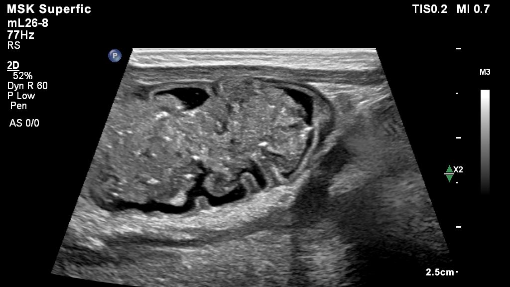 Pediatric bowel