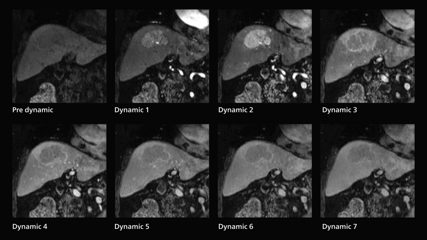 Dynamic MRI of liver using SmartSpeed
