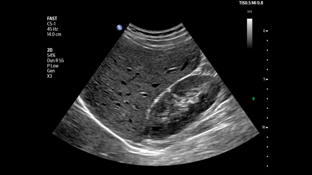 Upper right quadrant liver and kidney shown using C5-1 transducer on Flash 5100 POC. 
