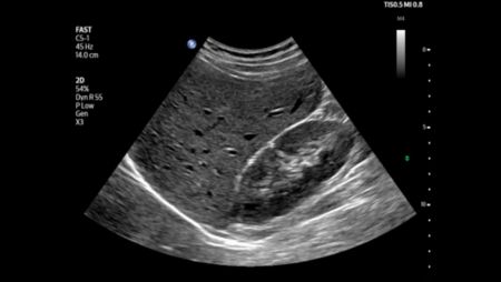 Upper right quadrant liver and kidney shown using C5-1 transducer.