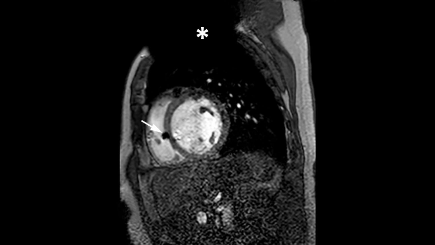MRI of heart with MR Conditional ICD