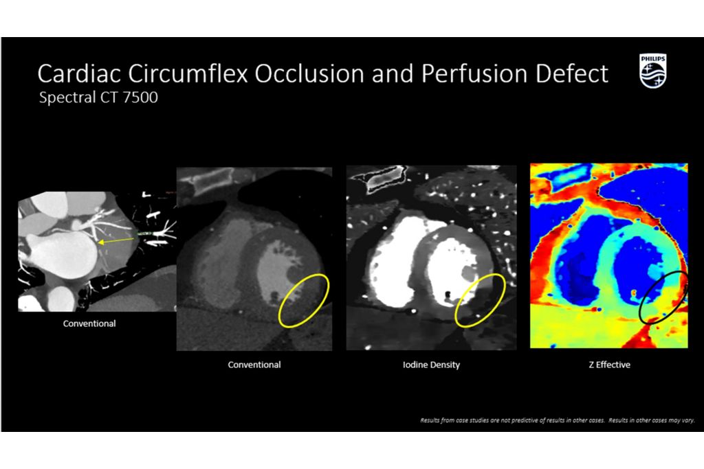 CT Spectral 7500 Cardiac Circumflex