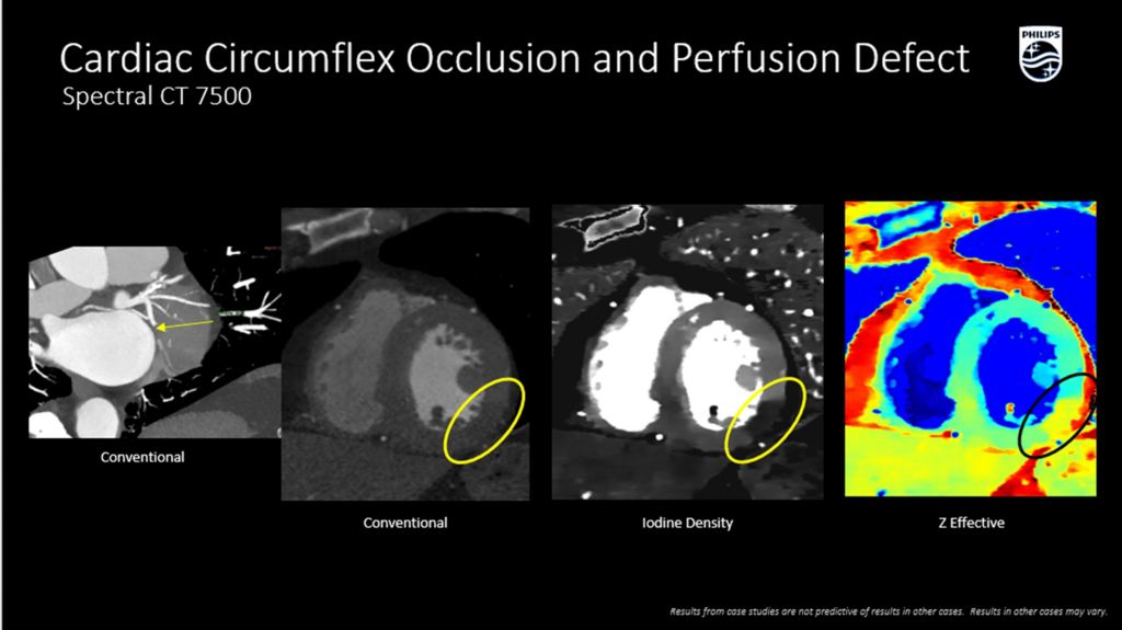 CT Spectral 7500 Cardiac Circumflex