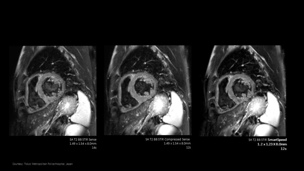 Comparison between SENSE, Compressed SENSE and SmartSpeed for Black Blood imaging