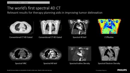 World’s-first spectral 4D CT