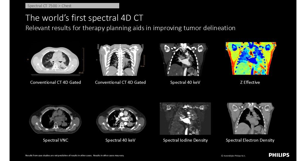 World’s-first spectral 4D CT