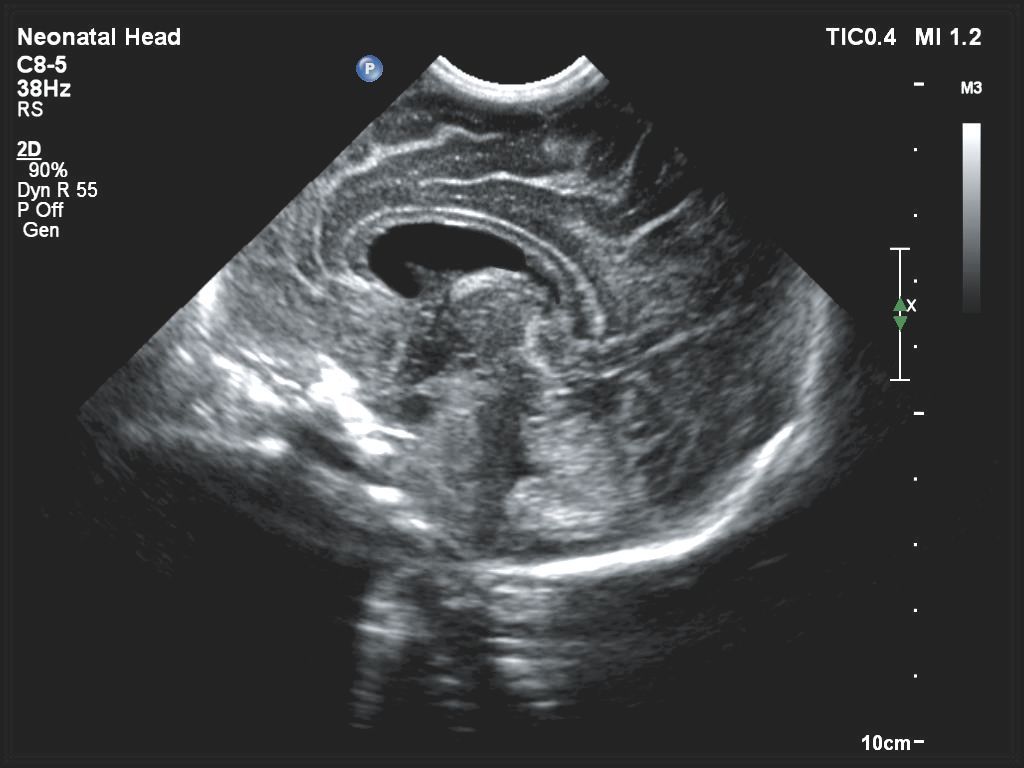 Affiniti 30 ultrasound clinical image obstetric neonatal head