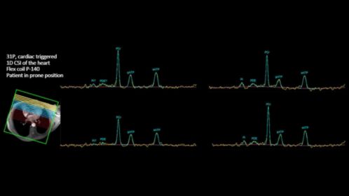 Multi Nuclei Cardiac 31P