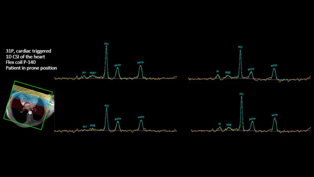 Multi Nuclei Cardiac 31P