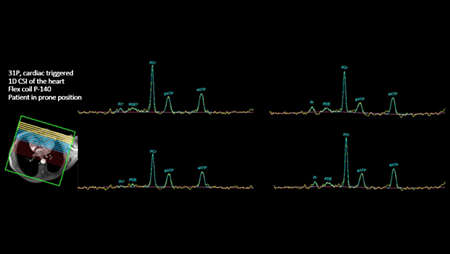 Multi Nuclei Cardiac 31P