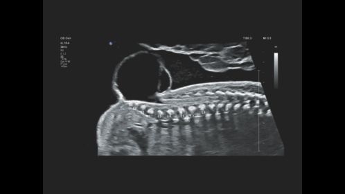 EPIQ Elite myelomeningocele demonstrated using the eL18-4