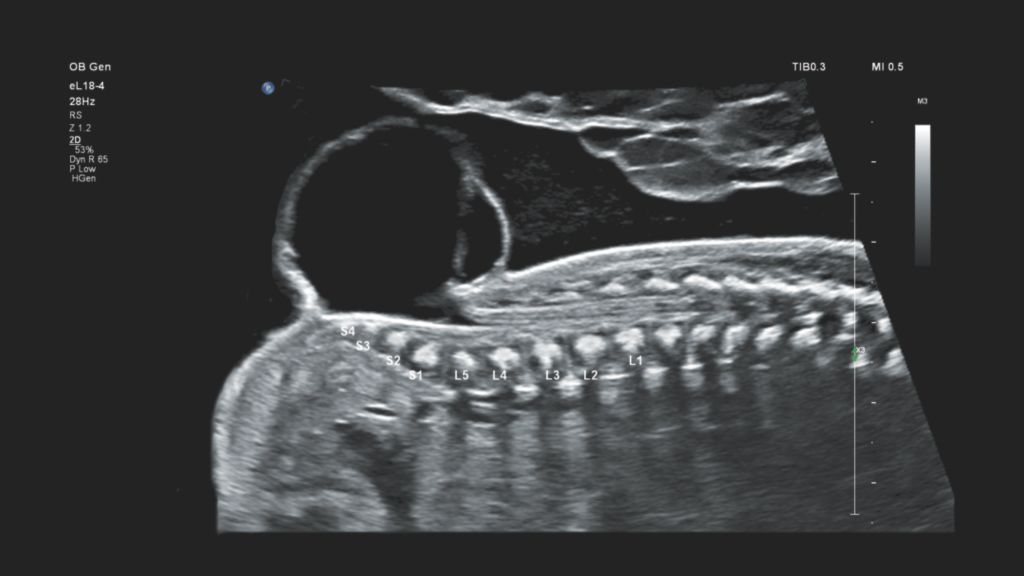 EPIQ Elite myelomeningocele demonstrated using the eL18-4