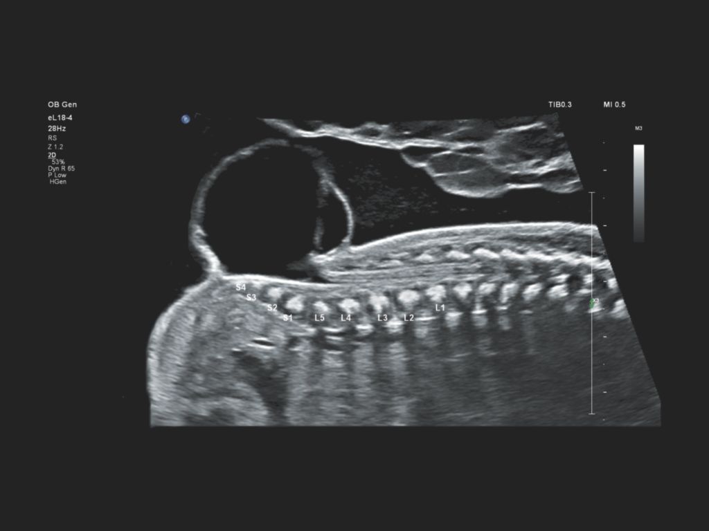 EPIQ Elite myelomeningocele demonstrated using the eL18-4