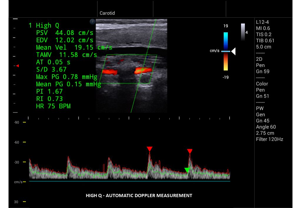 InnoSight clinical image High Automatic Doppler measurement