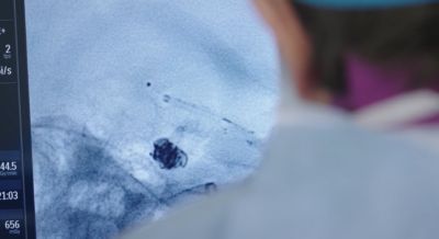 Imagem de angiografia cerebral mostrando bloqueio vascular relacionado a acidente vascular cerebral (AVC)