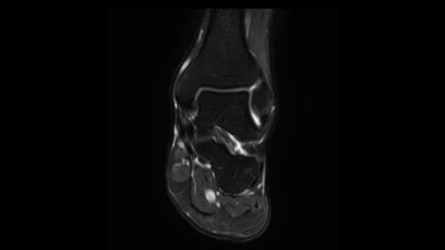 Coronal T2w SPIR