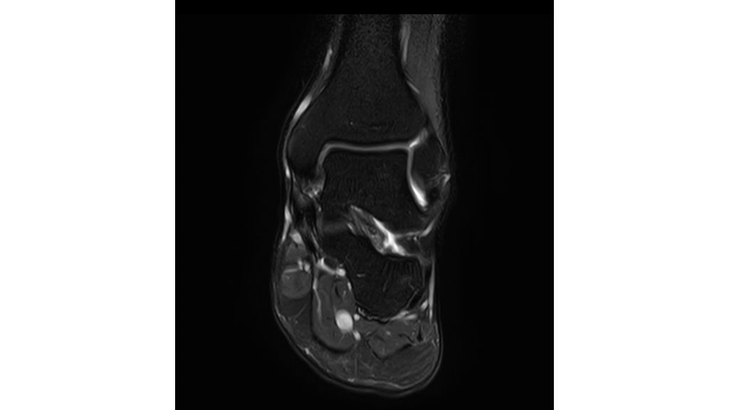Coronal T2w SPIR