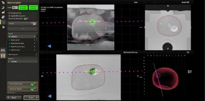 Philips UroNav system showing MR and ultrasound fusion image with advanced annotation tools