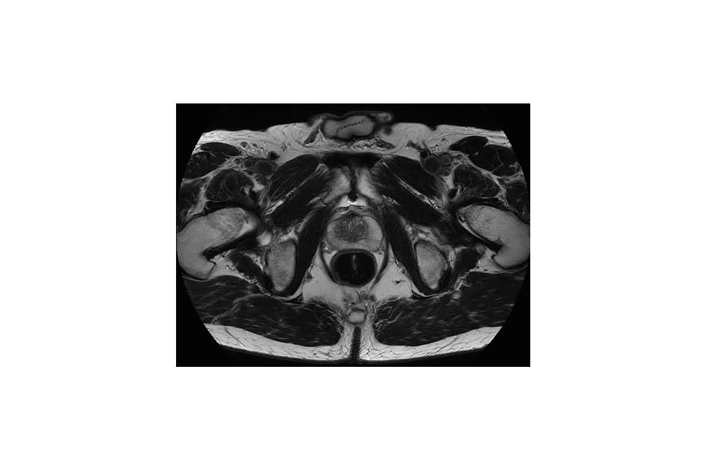 Philips - MultiVane XD - Pelvis MR clinical application Philips - MultiVane XD - Pelvis MR clinical application