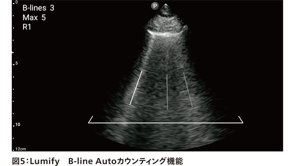 図5：Lumify　B-line Autoカウンティング機能