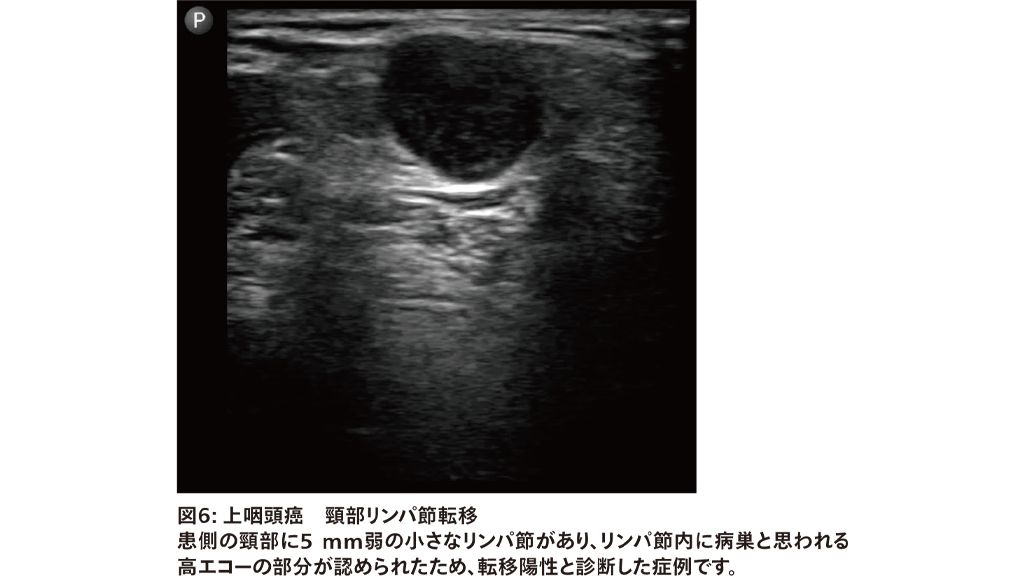 図6: 上咽頭癌　頸部リンパ節転移　