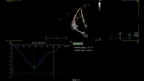 Ultrasound Workspace AutoStrain RV