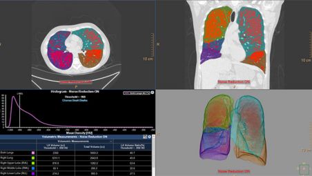 Quantificação avançada dos volumes pulmonares afetados