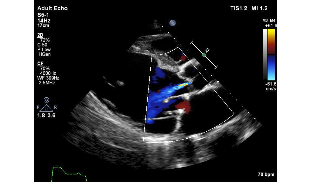 Adult echo