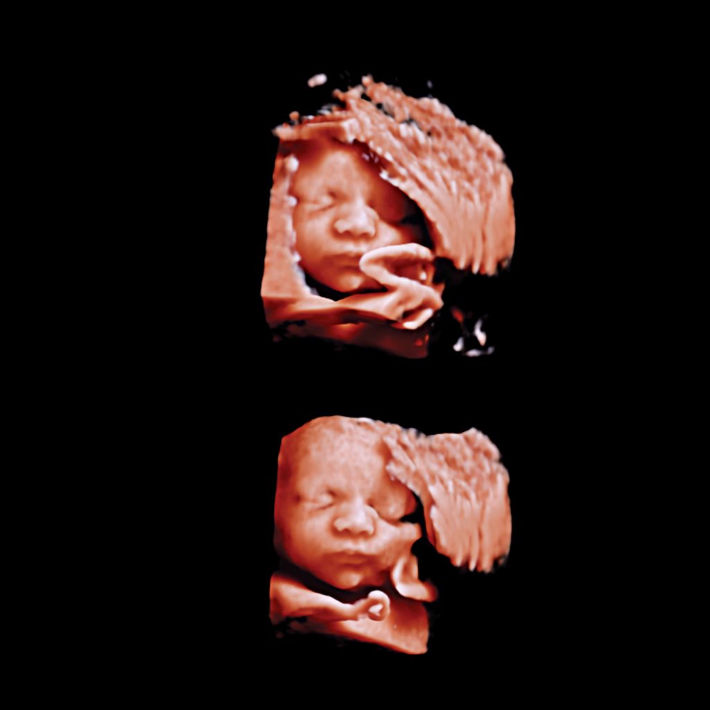 3D ultrasound image of baby face with 3D Auto Edit used