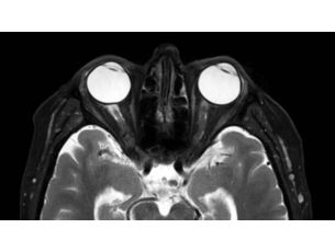 mDIXON XD TSE - Brain MR Clinical application