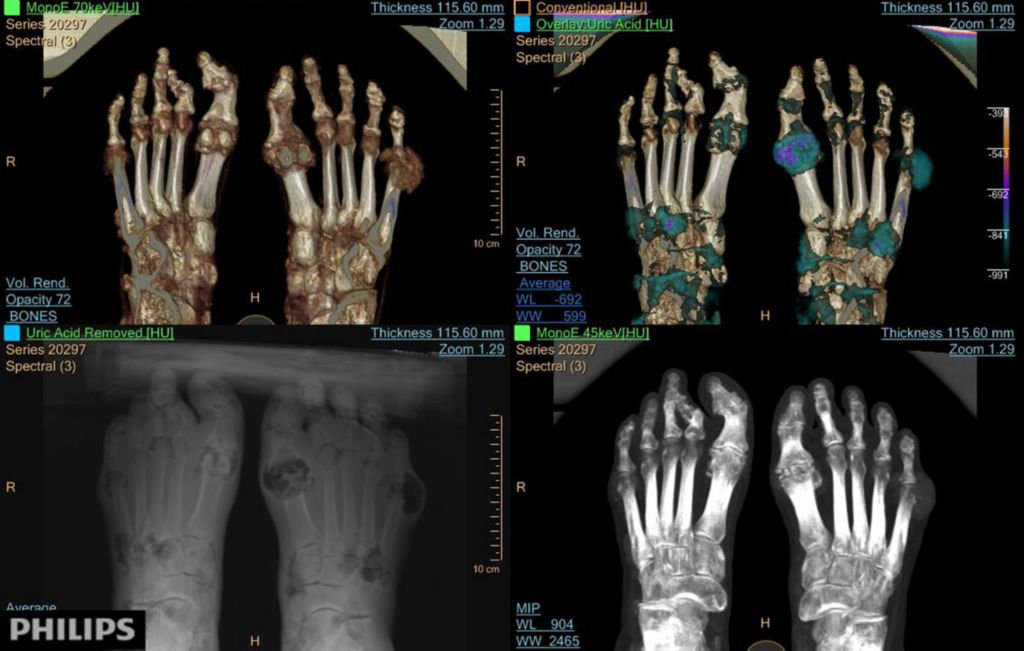 Gout in the foot