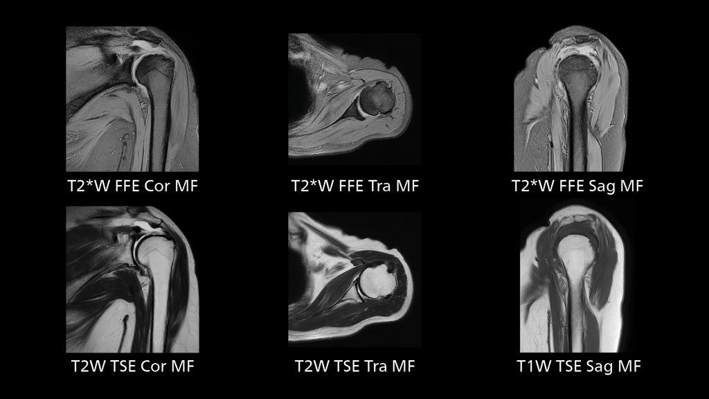 Routine MRI of shoulder with SmartSpeed MotionFree