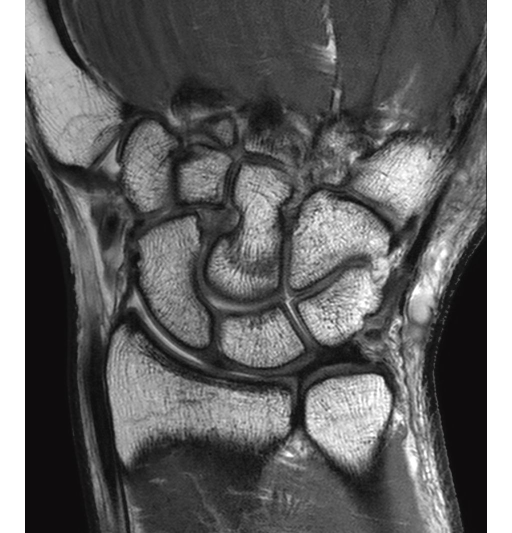 Coronal PDw TSE
