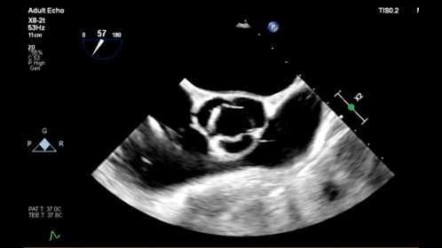 Affiniti CVx X8-2t SAX Aortic Valve