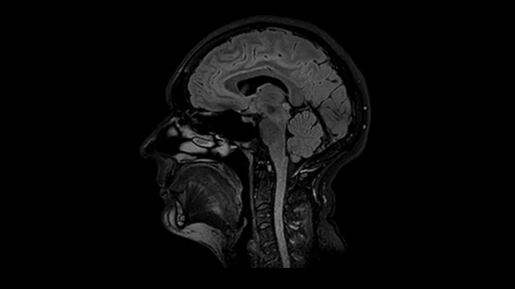 3D FLAIR clinical image of the brain